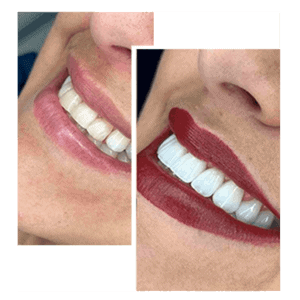 Facetas-de-Resina-1-768x768