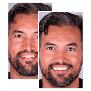 Lentes-de-Contato-Dental-1-768x768